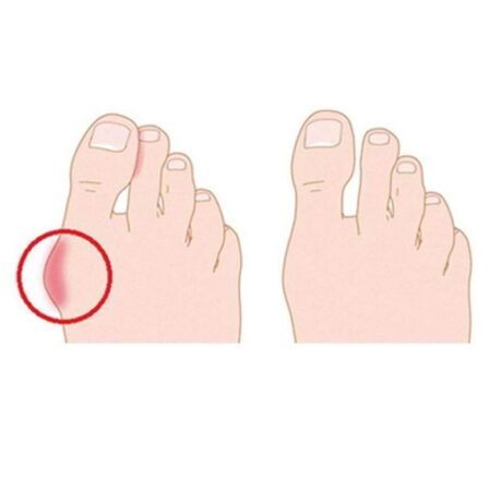 Διορθωτικοί Νάρθηκες Σιλικόνης Δαχτύλων Ποδιών Σετ